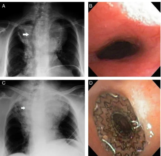 Figure 1 (A) Chest X-ray showing a large mediastinal mass with marked deviation of the trachea to the right with tracheal compression, (B) bronchoscopic view of the trachea showing the narrowing, (C) chest X-ray after the stent placement showing the stent 