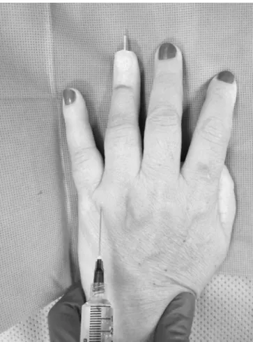 Figure 2 Subcutaneous blockade of the dorsal and palmar nerves of right index finger. Illustration: Gladys N