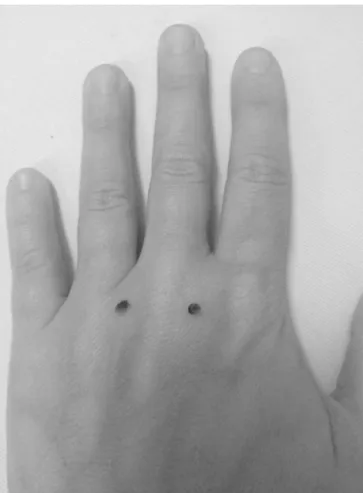 Figure 5 Transthecal blockade. The puncture for anesthetic solution administration is performed in the sheath of the finger flexor tendon (proximal level of the palmar digital crease or a little more distal)