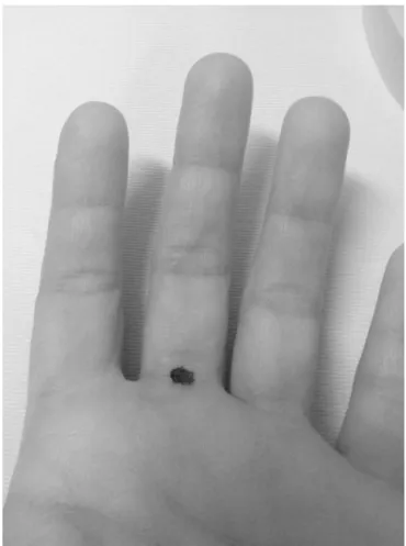 Figure 6 Location for hand finger block using only one local anesthetic injection into the subcutaneous space and applied approximately at the level of the midpoint of palmar interdigital crease.