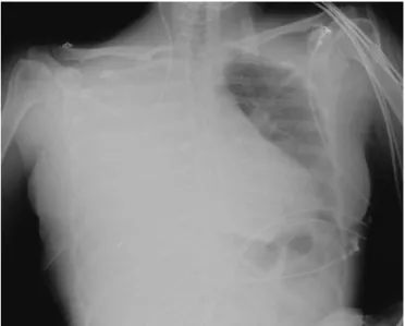 Figure 1 Portable chest X-ray showing right hydrothorax 9 h after insertion of the central venous catheter.