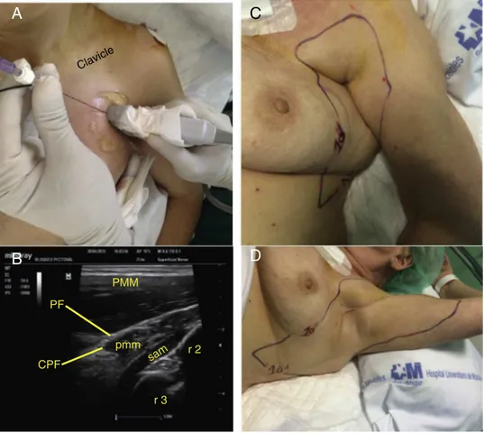 Figure 2 Ultrasound-Guided Anterior-Approach SIFP Block prior to undergoing tumorectomy in the outer quadrant and sentinel node biopsy