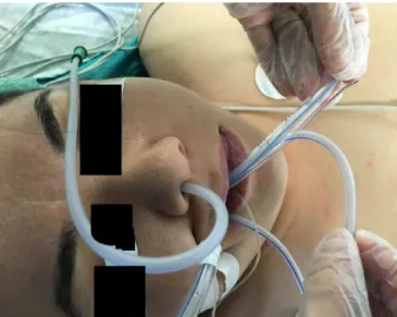Figure 1 Endotracheal tube assisted technique.