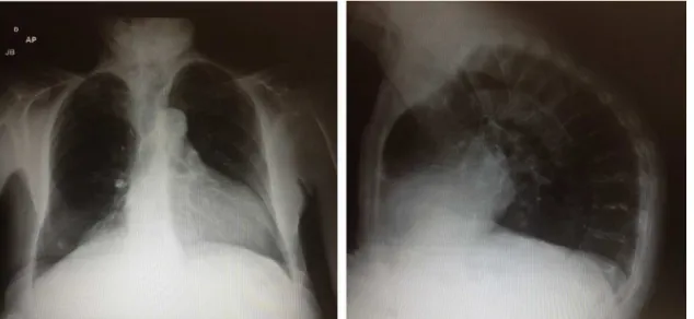 Figure 1 Preoperative chest X-ray.