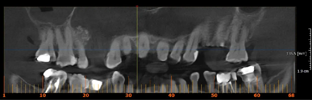 Figura 9 – Vista seccional sagital arcada superior para visualização do defeito vertical por mesial dente 12  (30-32mm) 