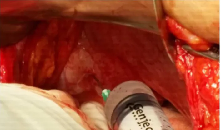 Figure 3 Intra-abdominal access of a blunt-ended needle into the transversus abdominis plane through the transversus  abdo-minis muscle (surgical TAP block).