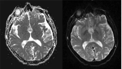 Figure 1 Cranial computed tomography and diffusion magnetic resonance imaging.