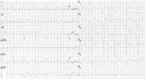 Figure 1 Preoperative 12-lead ECG with a LBBB-compatible pattern.
