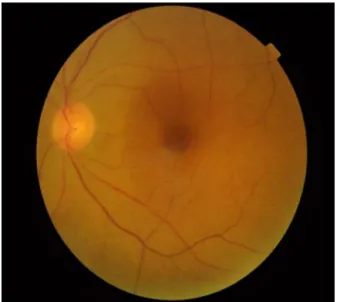 Figure 1 Fundus picture of left eye showing pallor. Retinal pallor with attenuated arteries.