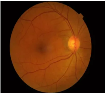 Figure 2 Normal fundus picture of right eye.