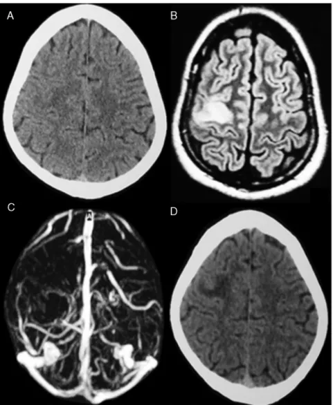 Figure 1 Imaging study of the case. A, B, C are tests performed on the first day of symptoms and D is the control examination performed after 10 days