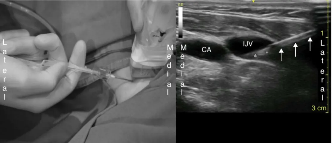 Figure 2 ‘‘Syringe-Free’’ approach and corresponding sonographic image. CA, carotid artery; IJV, internal jugular vein; * *, guide wire; ↑ ↑ ↑, needle.