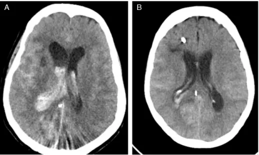 Figure 3 Postprocedure computed tomography scan showing an intraventricular hemorrhage and hydrocephalus before (A) and after drainage (B).