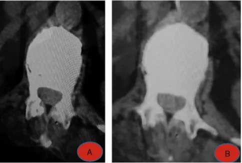 Figure 4 (A and B) Postoperative CT.