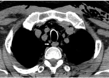 Figure 1 Paratracheal cyst rupture.