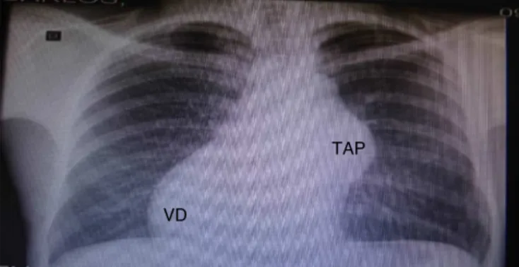 Figura 1 Radiografia de tórax: aneurisma de TAP, aumento do VD e desvio da área cardíaca para direita