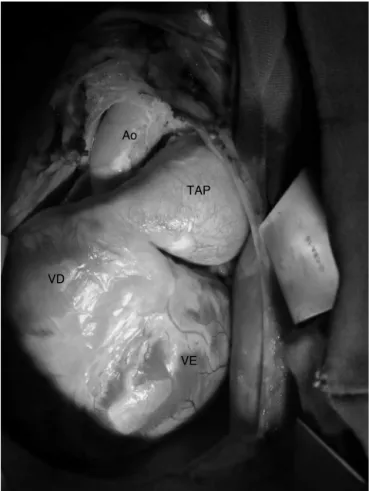 Figura 2 Aneurisma de TAP e aumento do VD. TAP, tronco de artéria pulmonar; VD, ventrículo direito; Ao, aorta; VE,  ventrí-culo esquerdo.