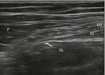 Figure 1 Ultrasound of the lumbar square approach type II (described by R. Blanco). EO, external oblique muscle; IO,  inter-nal oblique muscle; QL, quadratus lumborum muscle; P, psoas major muscle; arrow, injection site.