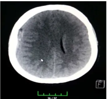 Figure 1 CT scan showed a right subdural hematoma.