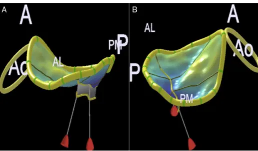 Figure 10 Mitral annulus assessment by three-dimensional echocardiography. (A) Anteroposterior diameter