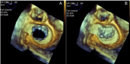 Figure 13 Mitral valve view in three-dimensional image. (A) Mitral valve in diastole. (B) Mitral valve in systole.