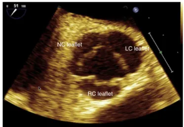 Figure 18 Aortic complex. LV, left ventricle; LVOT, left ven- ven-tricular outflow tract; RVOT, right ventricular outflow tract.
