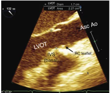 Figure 20 Mid-esophageal aortic valve long axis cross- cross-section. LVOT, left ventricular outflow tract; IVS,  interventric-ular septum; RC, right coronary; Asc Ao, ascending aorta.