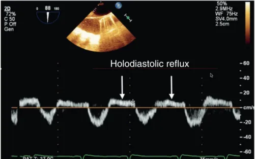 Figure 23 Pulsed Doppler in descending aorta showing a holodiastolic reflux of severe aortic regurgitation.