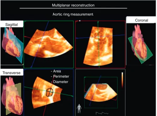 Figure 26 Multiplanar reconstruction in assessing aortic valve area.