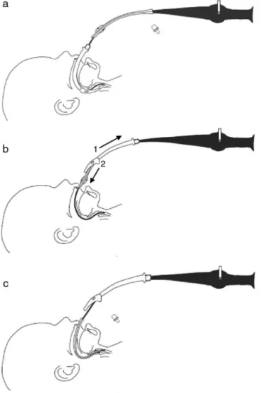 Figure 1 Fiberoptic intubation method through a laryngeal mask airway (LMA) described by Ellis et al
