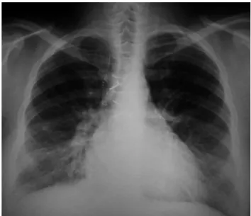 Figura 1 Radiografia de tórax em PA que evidencia opacida- opacida-des reticulares simétricas em campos pulmonares inferiores que podem corresponder a espessamentos de septos interlobulares devido à cardiopatia, aumento da área cardíaca, fios metálicos de 