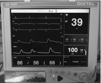Figura 4 Padrão de monitorizac ¸ão após colocac ¸ão da paciente em posic ¸ão semissentada que evidencia bradicardia e  hipoten-são.