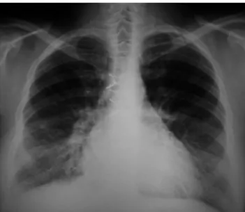 Figure 1 PA chest X-ray showing symmetrical reticular opac- opac-ities in lower lung fields that may correspond to interlobular septa thickening due to heart disease; cardiomegaly;  ster-notomy wires, and mediastinal clips.