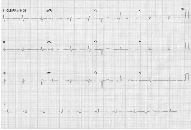 Figure 2 Electrocardiogram 12-lead showing inactive area in the inferior wall, isolated ventricular extrasystole, and diffuse changes of ventricular repolarization.