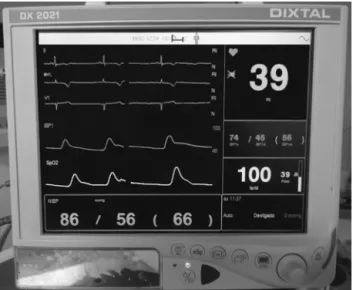 Figure 4 Monitoring pattern after placing the patient in semi- semi-sitting position, which shows bradycardia and hypotension.