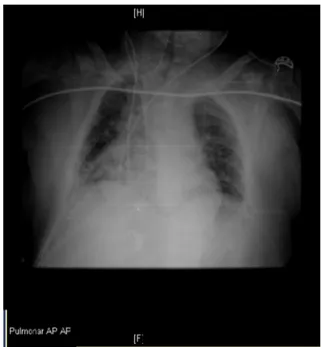 Figure 1 Postoperative chest X-ray performed after CVC placement in the right internal jugular vein.