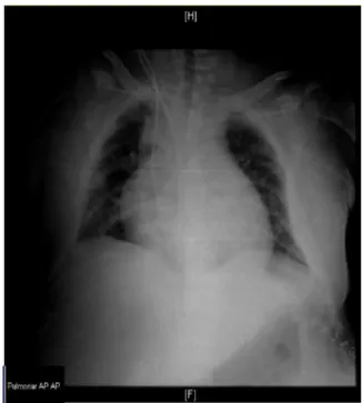 Figure 3 Chest X-ray performed 17 days after CVC placement (after pericardiocentesis).