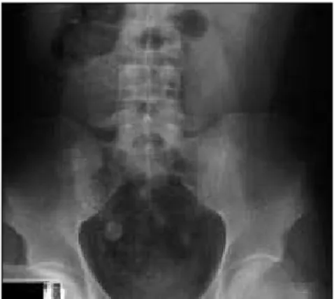 Figura  1.  Radiografia  simples  de  abdome.