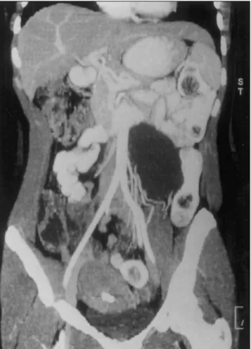 Figura 3. Tomografia computadorizada do abdome com contraste iodado endovenoso. Reconstrução no plano coronal.