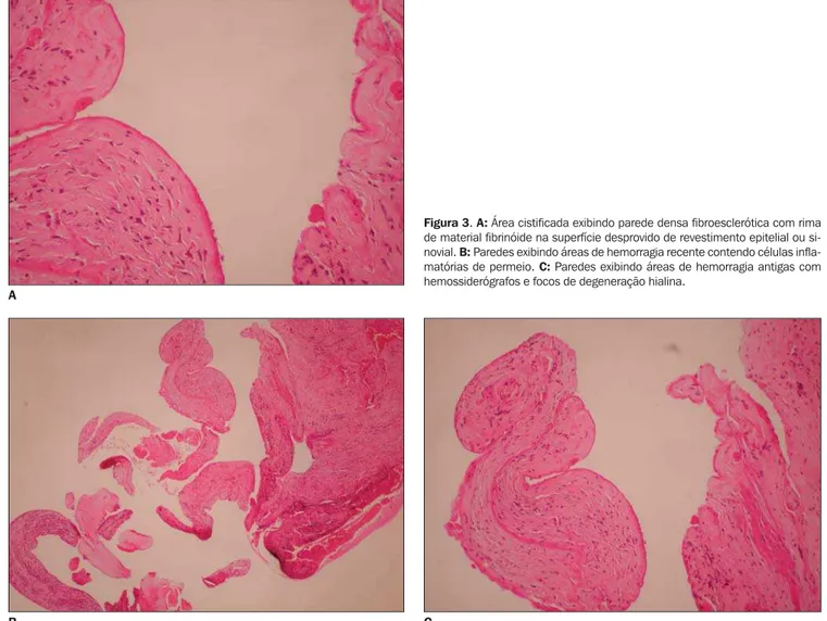 Figura 3. A: Área cistificada exibindo parede densa fibroesclerótica com rima de material fibrinóide na superfície desprovido de revestimento epitelial ou  si-novial