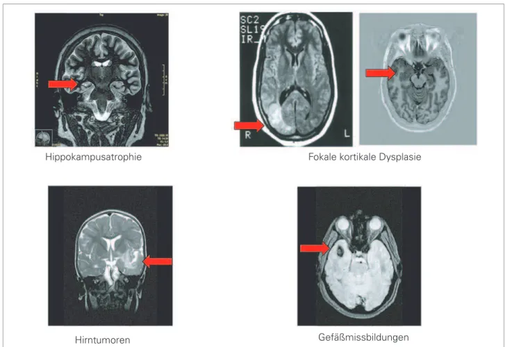 Abbildung 5: Strukturelle Befunde bei symptomatischen Epilepsien