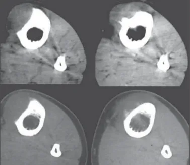 Figura 2. Imagens axiais de tomografia computadorizada, janela de partes mo- mo-les (acima) e janela óssea (abaixo).