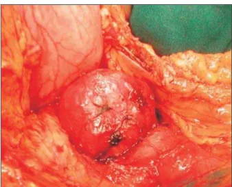Figura 3. Tumor estromal no duodeno, em íntimo contato com o corpo do pâncreas.
