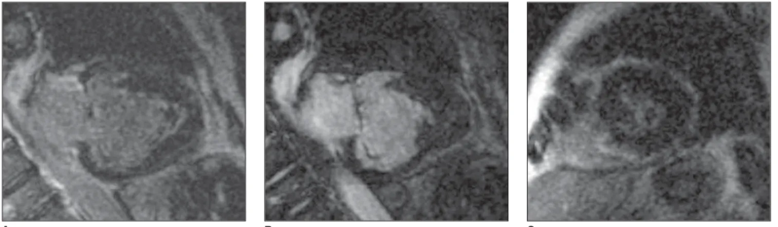 Figure 1. Electrocardiogram-gated acquisitions with cine Fiesta (SSFP), T1FGRET and T1FGRIR, at end-diastole, in the following planes: outflow tract (A), 2- 2-chamber view (B), 4-2-chamber view (C), short-axis (D); (E) LV function map, and (F) aortic flow 