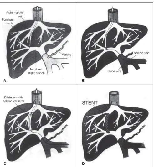 Figure 1. Schemes for TIPS technique comprehension. A: Insertion of an appropriate needle for punc- punc-turing the portal vein from the right hepatic vein
