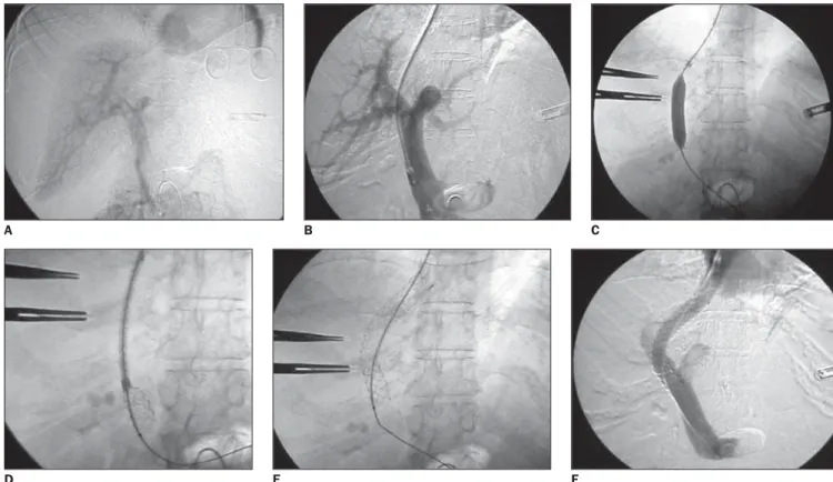 Figure 3. Angiography images documenting the utilization of a covered stent. A: Portal angiographic study