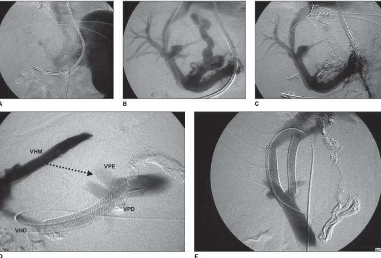 Figure 4. Documentation of some TIPS technical variables according to the strict portosystemic gradient control