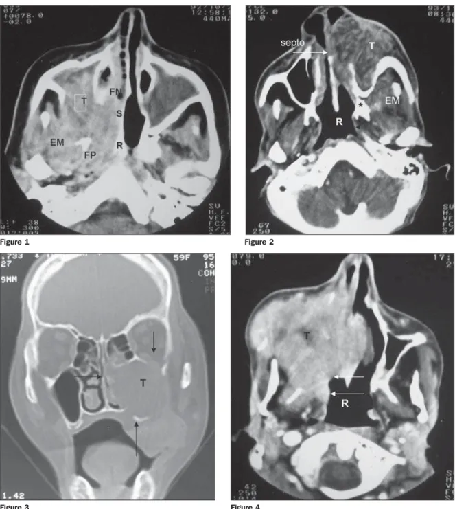 Figure 1. Epidermoid carcinoma. Axial view with soft tissues window. Heterogeneous, expansive lesion (T), with infiltrative aspect, centered on the right maxillary sinus, limited by: medially – sinus wall erosion and extension to the nasal fossa (FN) and n