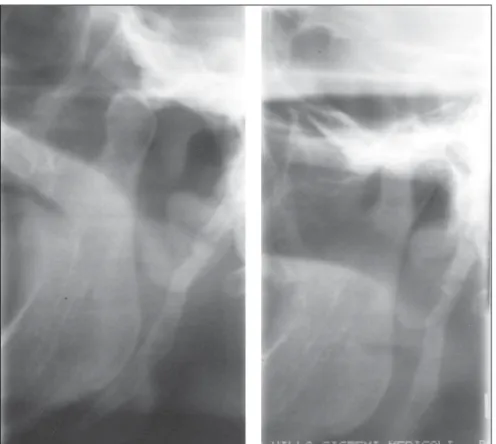 Figure 2. Left temporomandibular joint x-ray image, demonstrating morphological alteration of the styloid process.