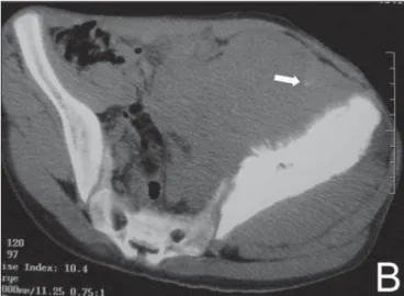 Figure 6. Case 6. Ewing’s sarcoma. Twelve-year-old boy. A: X-ray evidencing extensive sclerosis in left ilium, associated with soft tissue mass dislocating the bladder